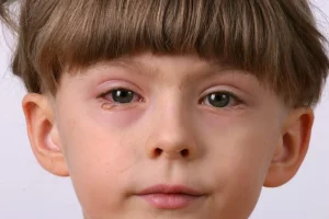 conjunctivitis